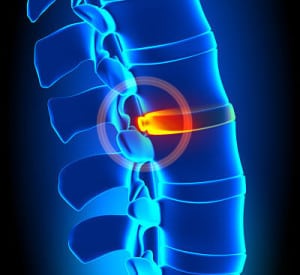 Common Bulging Disc Symptoms In Your Lower Back