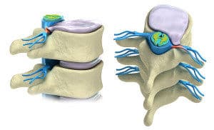 Bulging Disc vs Herniated Disc: Difference and Which Is Worse