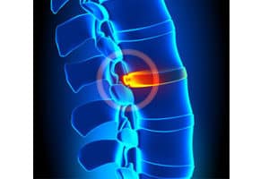 Bulging Disc vs Herniated Disc: What Is the Difference and Which Is Worse