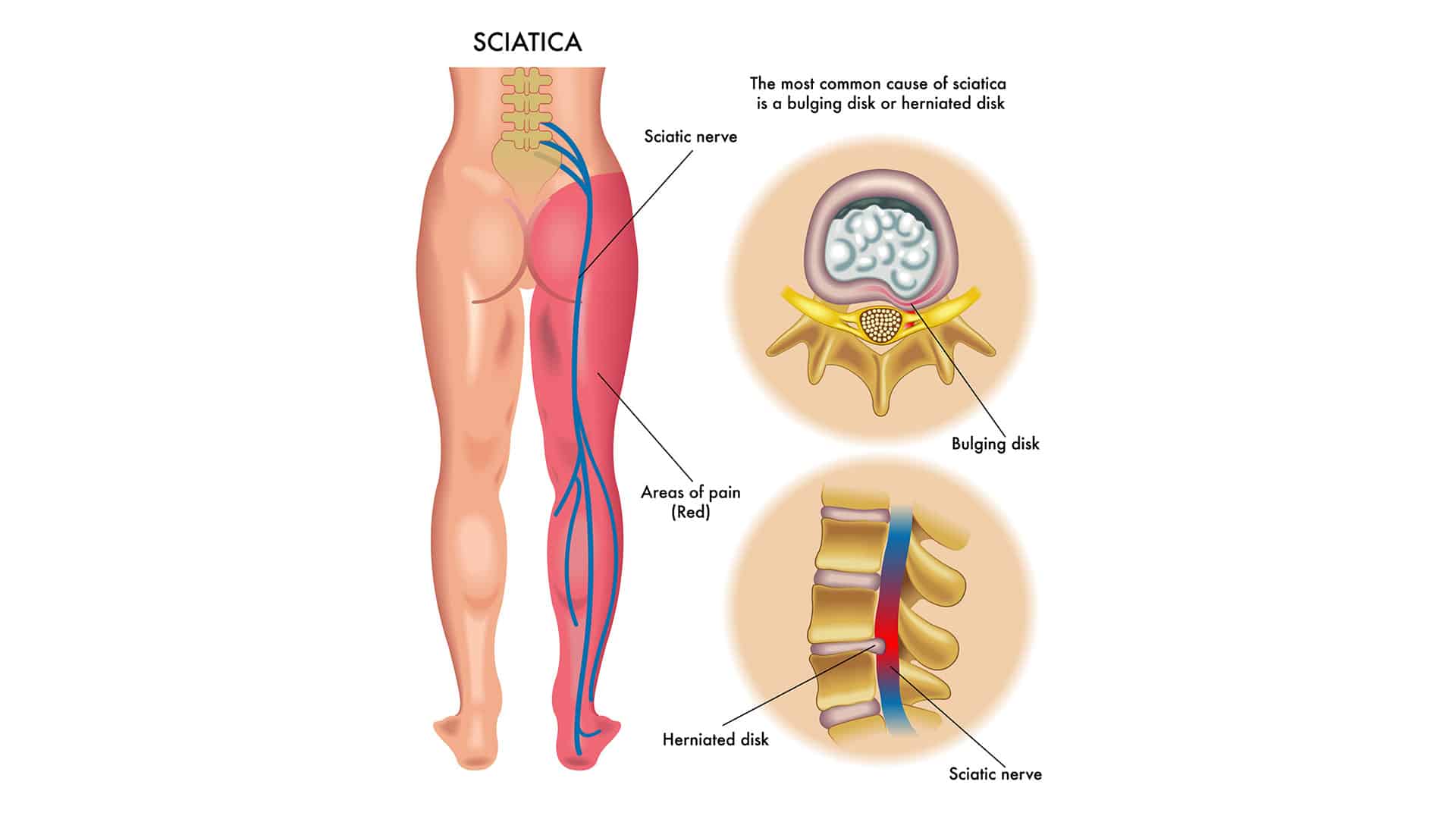 Inner thigh in glands swollen gland
