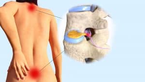 How-Bulging-Disc-Treatment-Can-Stop-Your-Pain