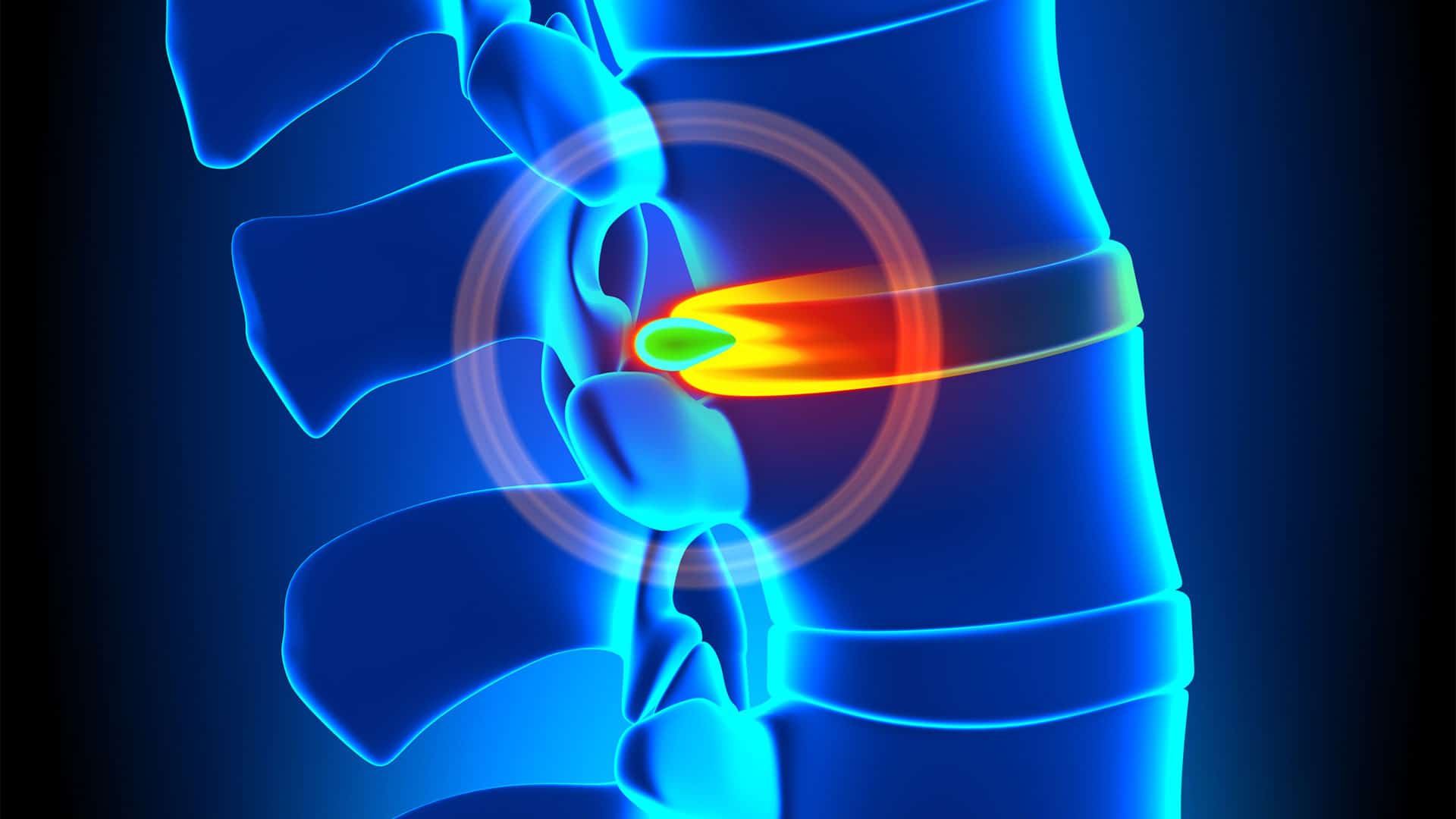 Common Bulging Disc Symptoms In Your Lower Back