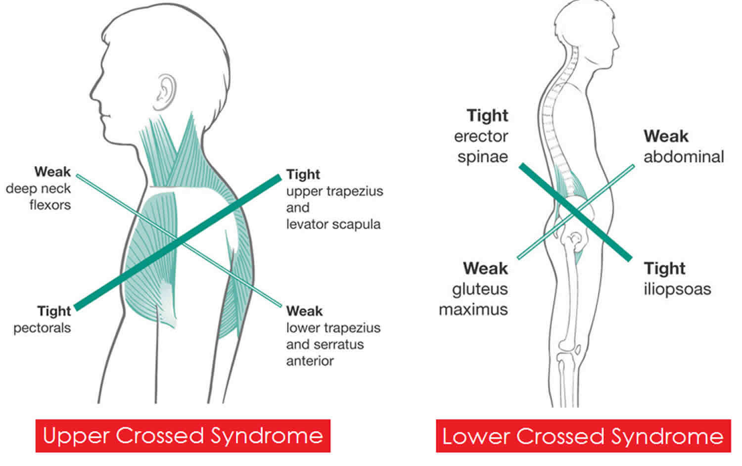 A) Normal posture. (B) Slouched posture. (C) Upright posture.