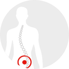 Sciatica Treatment